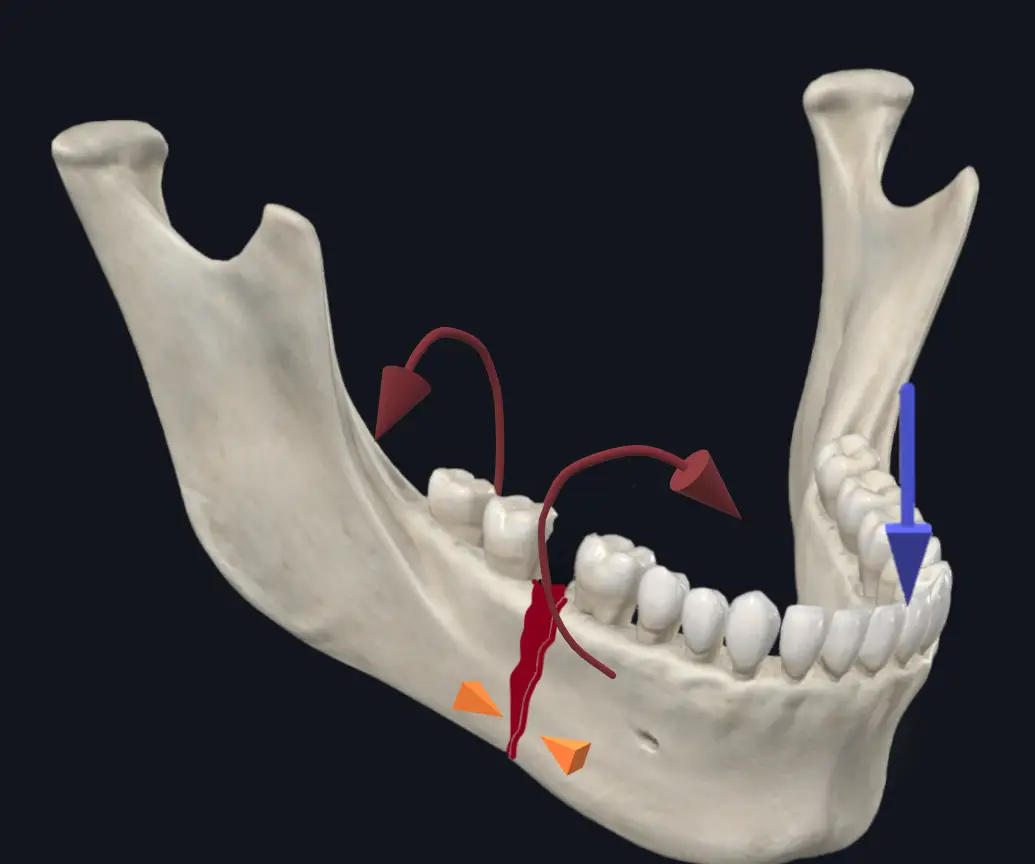 smilekraft fracture management