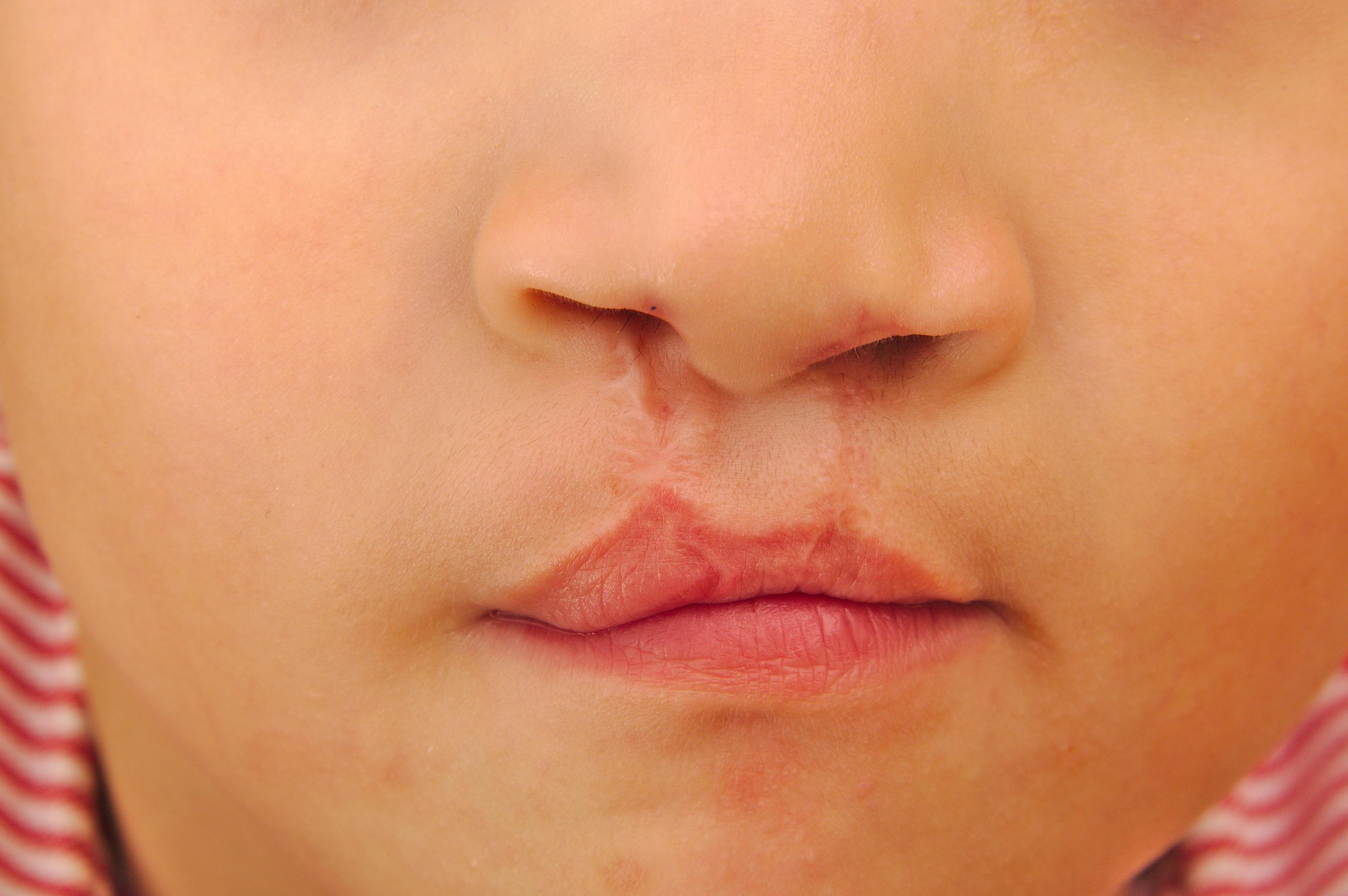 smilekraft cleft lip and palate surgery