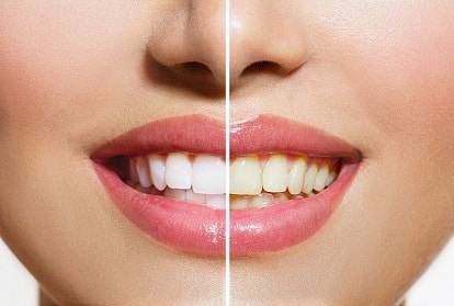 Bleaching Treatment