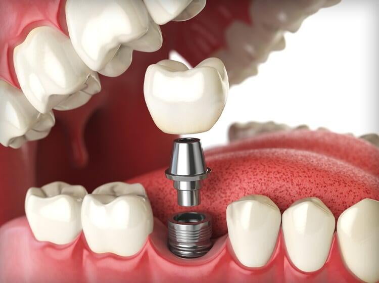 Implants