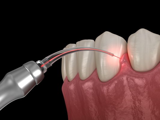 Gum Depigmentation