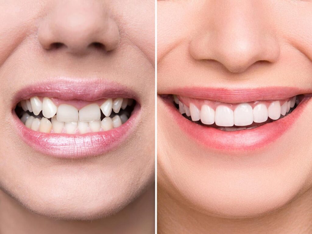 Smile Design